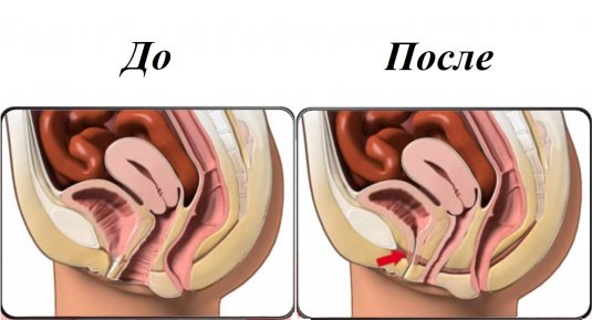 упражнения кегеля