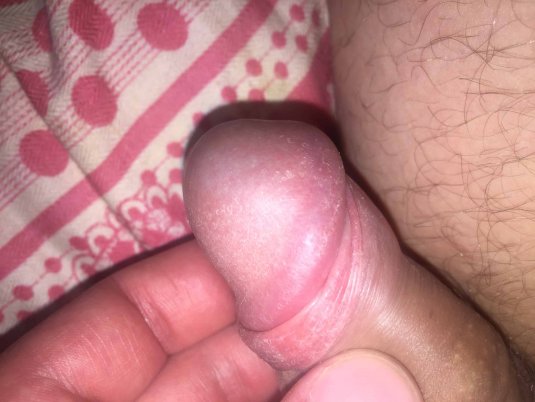 Высыпания на головке члена