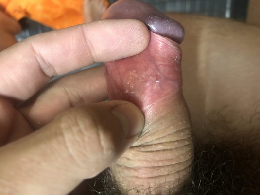 Здоровая головка полового члена