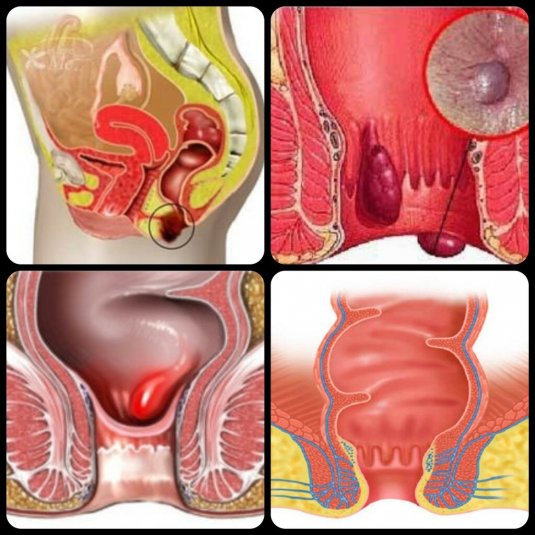 Геморроидальный узел геморроидальный