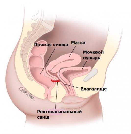 Ректовагинальный свищ