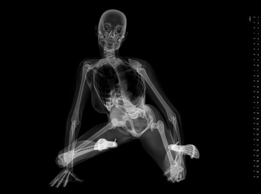 Рентген девушки