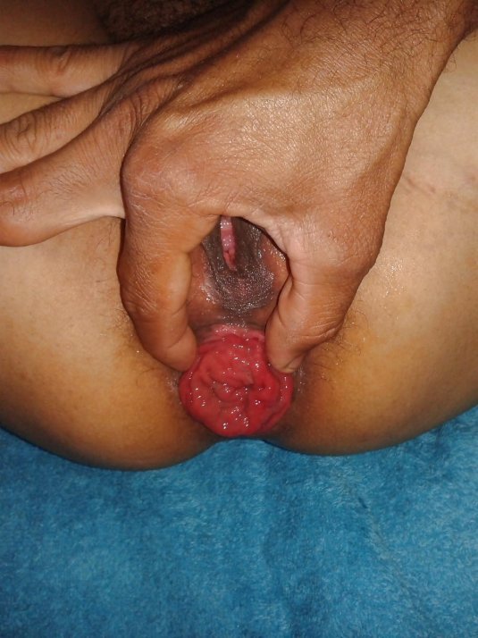 Синди Роуз Гаппинг пролапс