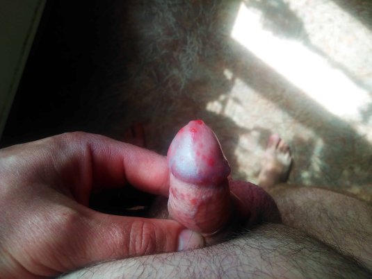 Красные пятна на половом члене