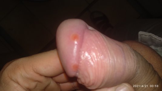 Красные пятнышки на головке члена