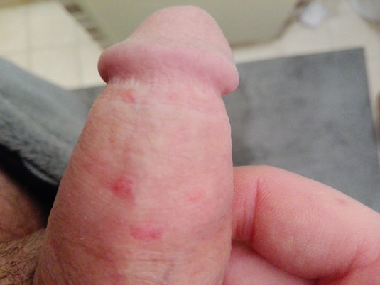 Сифилиз пятно на головке