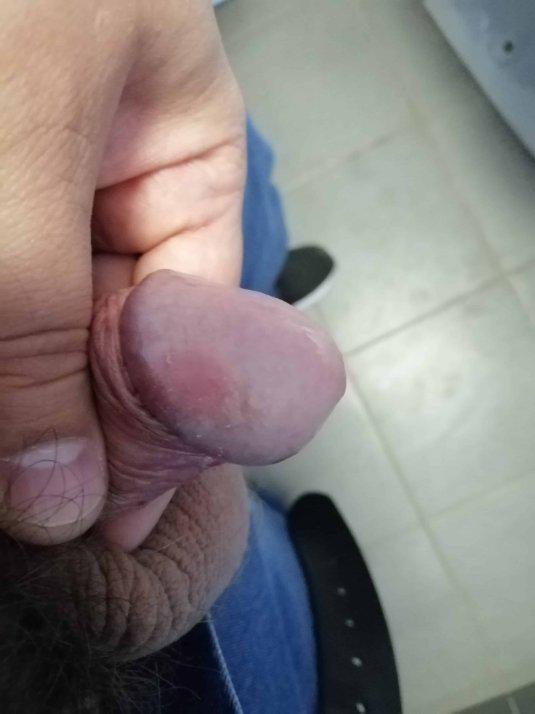 Красные пятна на головке полового члена