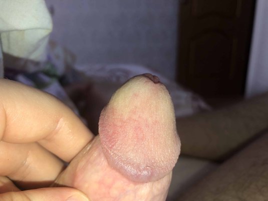 Грибковый баланопостит