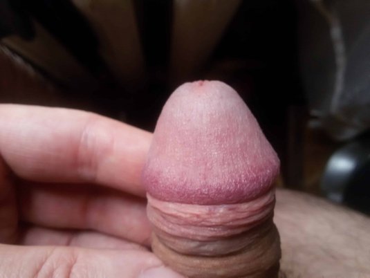 Пигментные пятна на головке члена