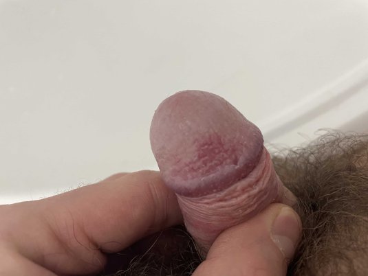 Маленькие прыщики на головке пениса