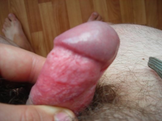 Маленькие красные пятнышки на пенисе