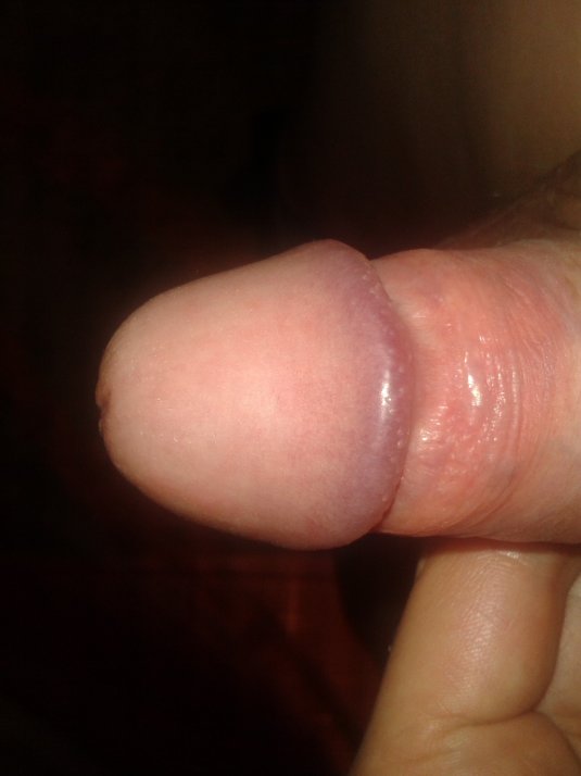 Красные пятна на залупе пениса