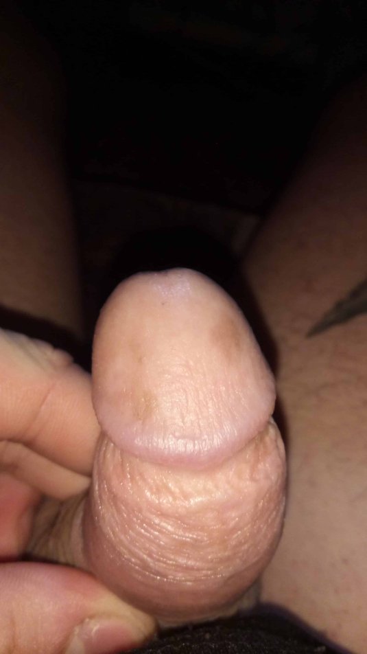 Красные пятнышки на пенисе