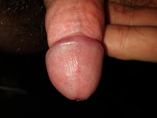 Белые пятнышки на головке пениса