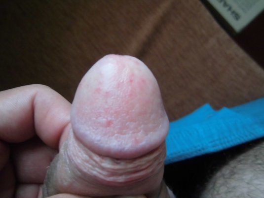 Воспаленная головка пениса