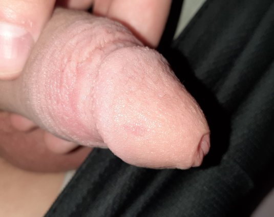 Катаральный баланопостит