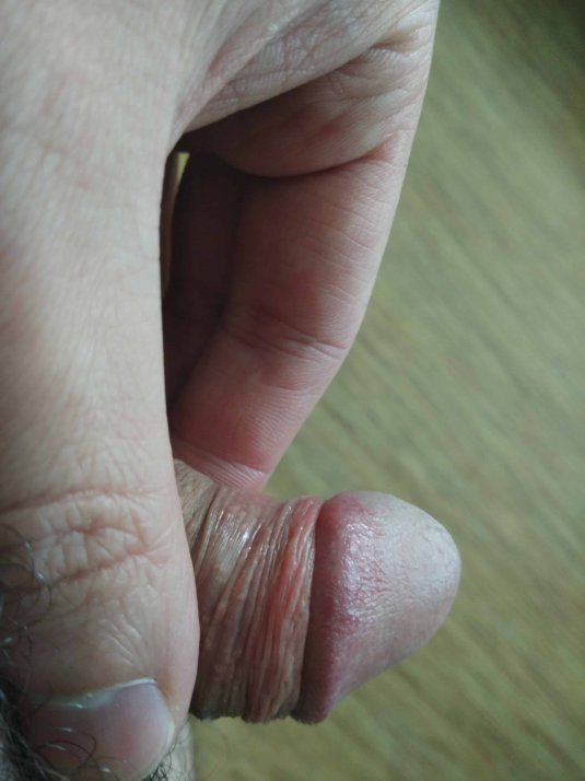 Маленькие прыщики на пенисе