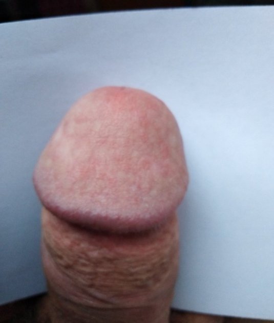 Белая пленка на головке полового члена