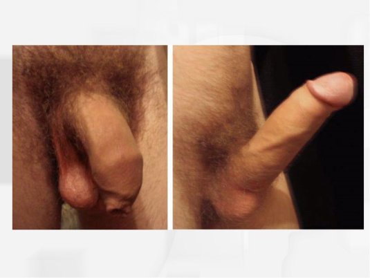 Мужской половой орган возбужденный