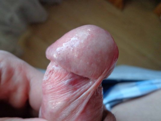 Красные пятнышки на залупе