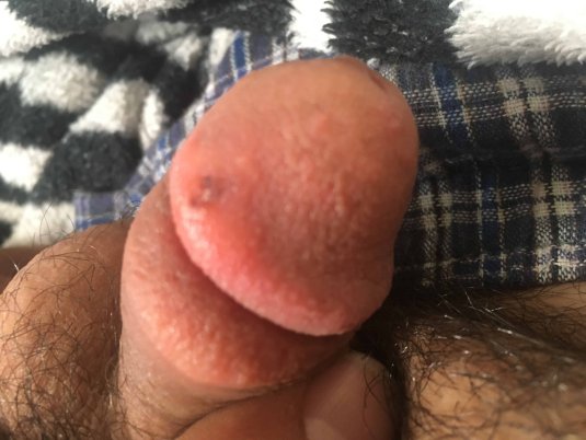 Красные пятна на половом члене