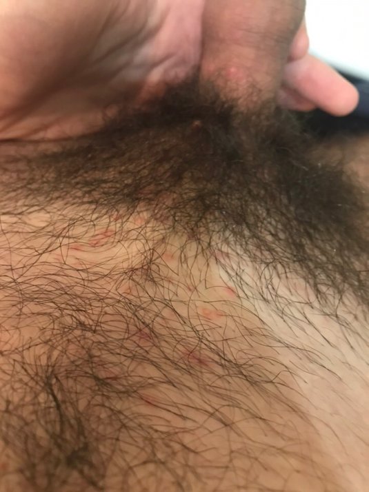 Вьющиеся волосы на лобке