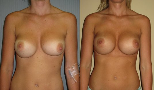Увеличенная грудь без одежды