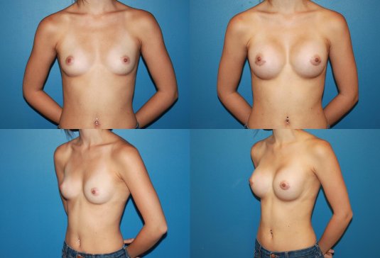 Сисиськи первого размера