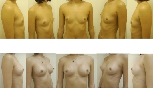 Редукционная маммопластика