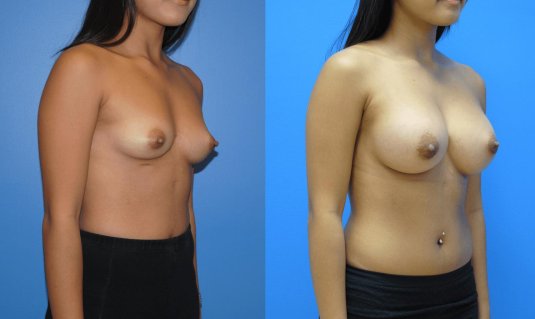 Редукционная маммопластика