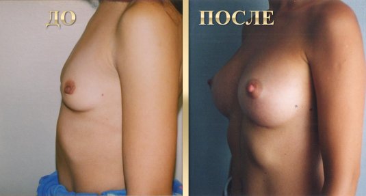 Грудь после маммопластики голая