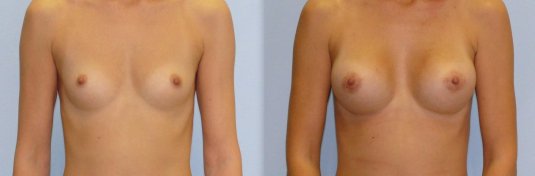 Редукционная маммопластика