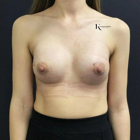 Пластика груди