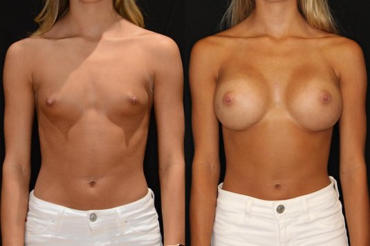 Breast augmentation