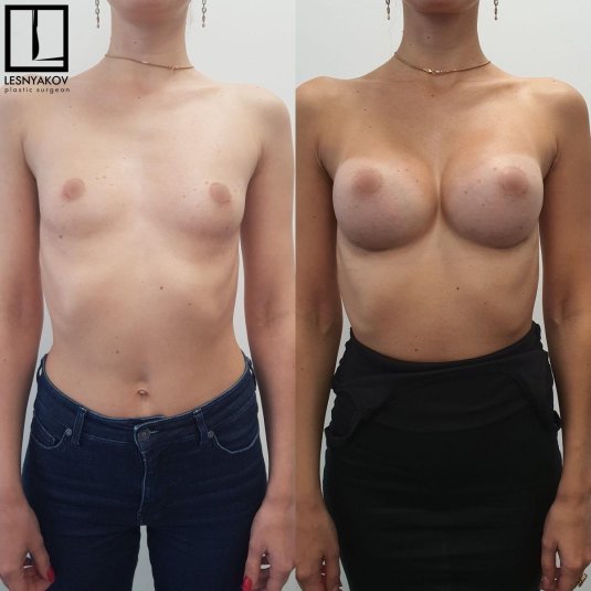 Имплант груди