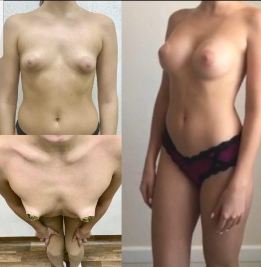 Тубулярная грудь пластика