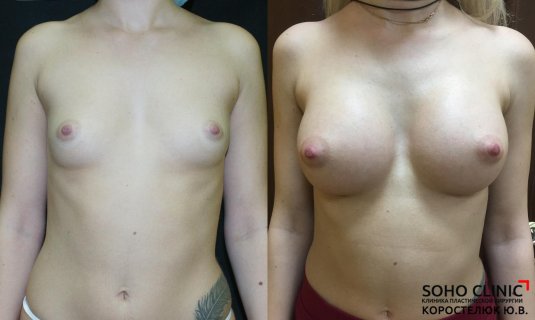 Пластика груди до и после