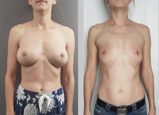 Силиконовая грудь