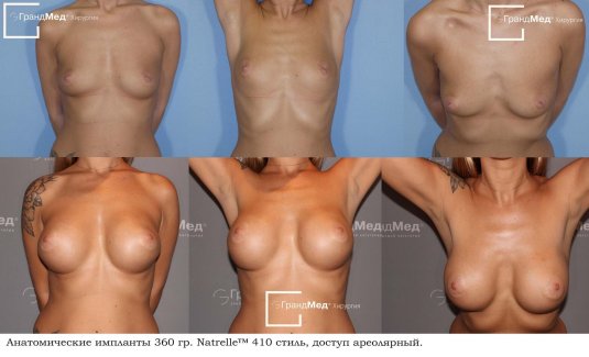 Красивая грудь с имплантами