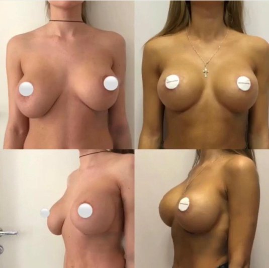 Красивая грудь с имплантами