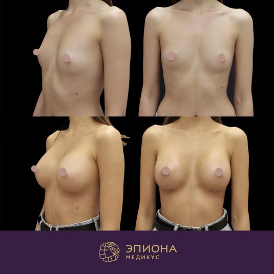 Увеличение груди анатомическими имплантами