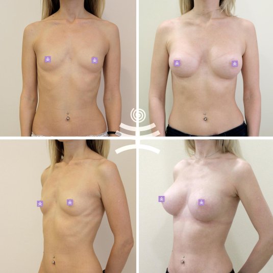 Анатомические импланты