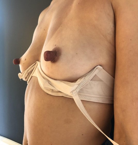 Тесный лифчик