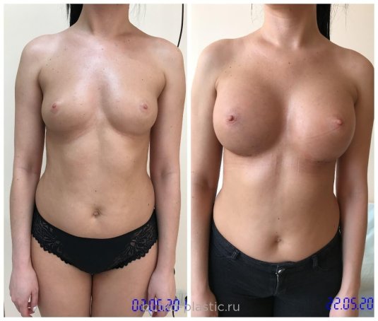 До и после увеличения груди