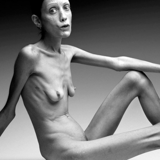 Изабель каро анорексия ню