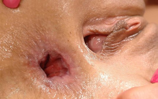 Эозинофильный эзофагит