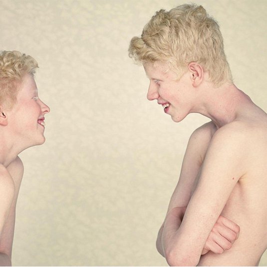 Альбинизм генная мутация