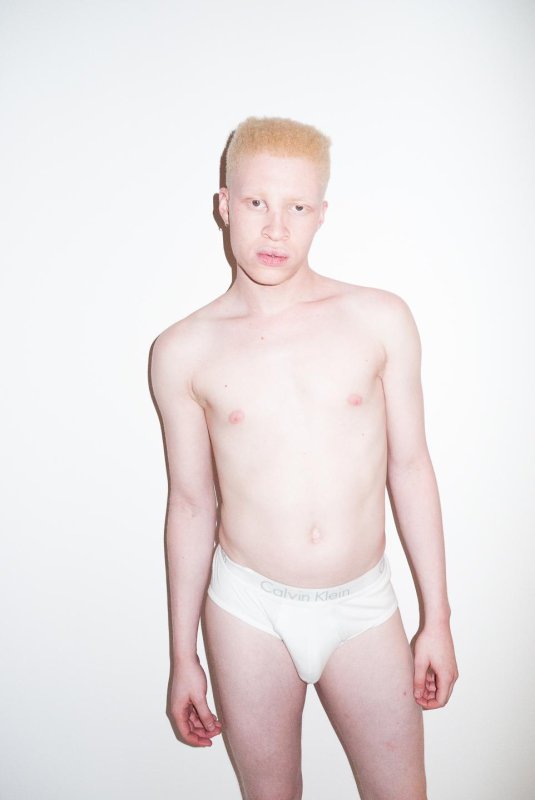 Альбинос парень