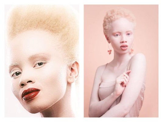 Афроамериканец альбинос