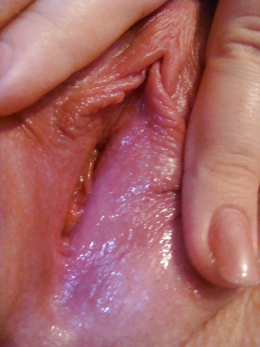 Папиллома влагалища
